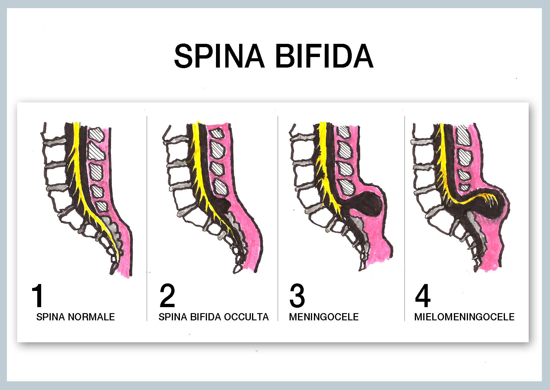 5. Spina Bifida Ribbon and Butterfly Tattoo - wide 7