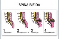 Spina Bifida | Quello che è utile sapere