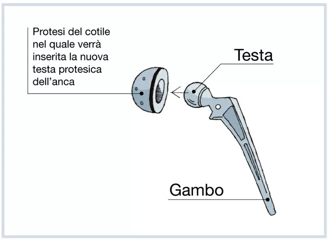 PROTESI ANCA