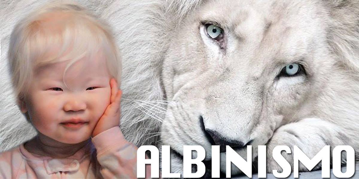 Albinismo ecco cosa significa e come si trasmette Albinismo ecco cosa significa e come si trasmette