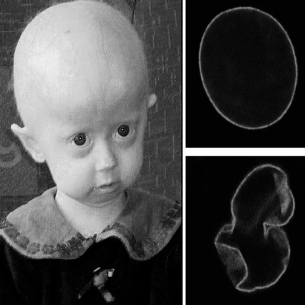 progeria sindrome da invecchiamento precoce