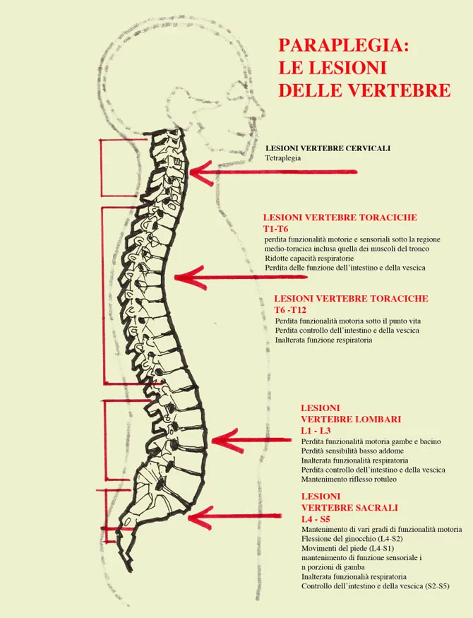 Paraplegia