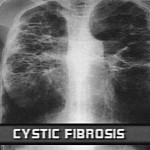 fibrosi cistica