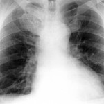 fibrosi polmonare idiopatica