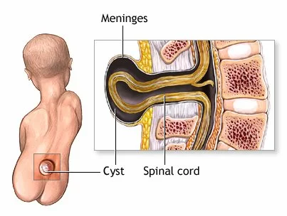 meningocele