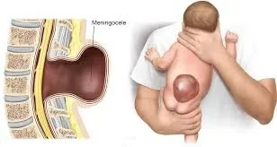 Meningocele