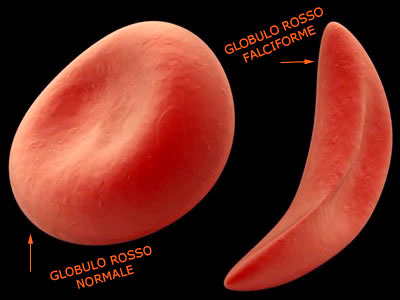 anemia falciforme