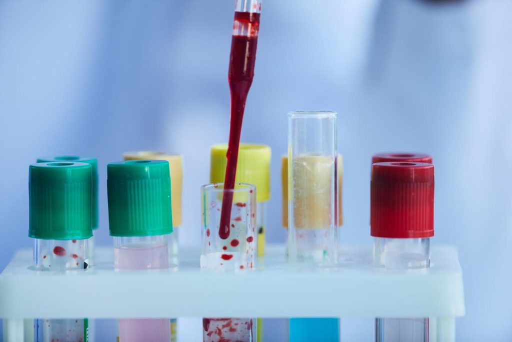 studiare sintomi anemia falciforme