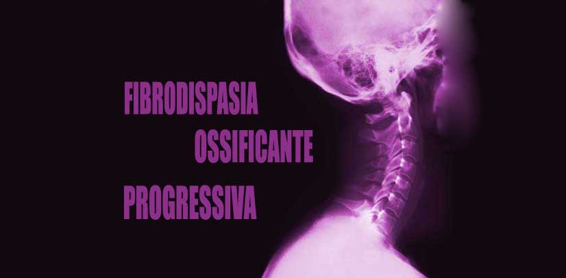Fibrodisplasia ossificante