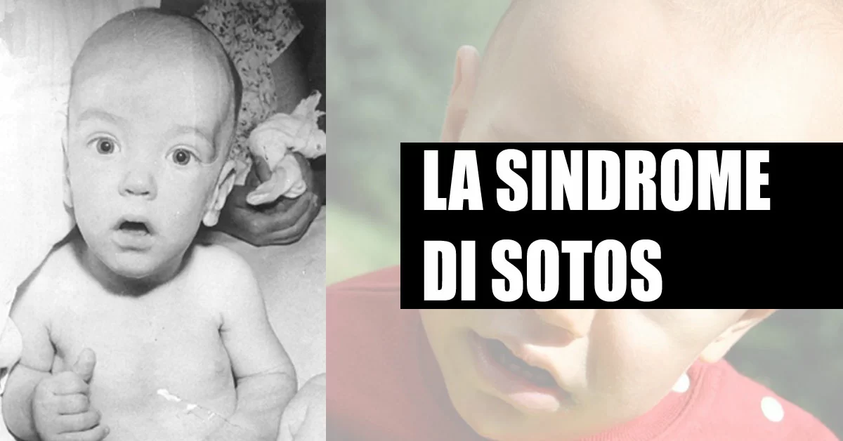 sindrome di sotos