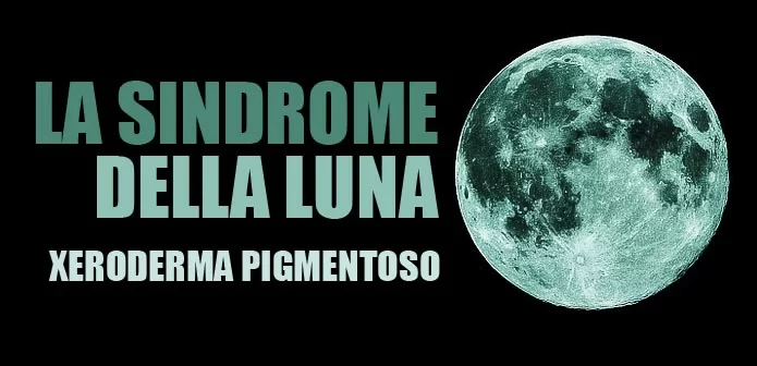 Sindrome della Luna ante