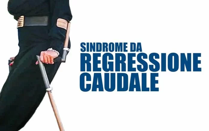 Sindrome regressione caudale2