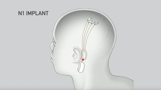 neuralink-neuralink elon musk-elon musk-ability channel-elon musk tecnologia-transumanesimo-intelligenza artificiale-neuralink paraplegici