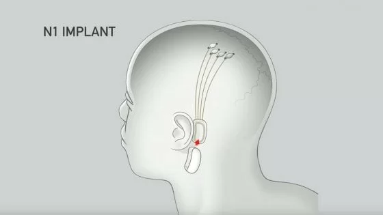 neuralink-neuralink elon musk-elon musk-ability channel-elon musk tecnologia-transumanesimo-intelligenza artificiale-neuralink paraplegici