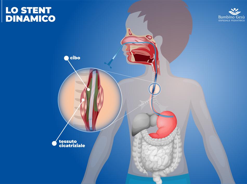 stent esofageo ospedale bambin gesù