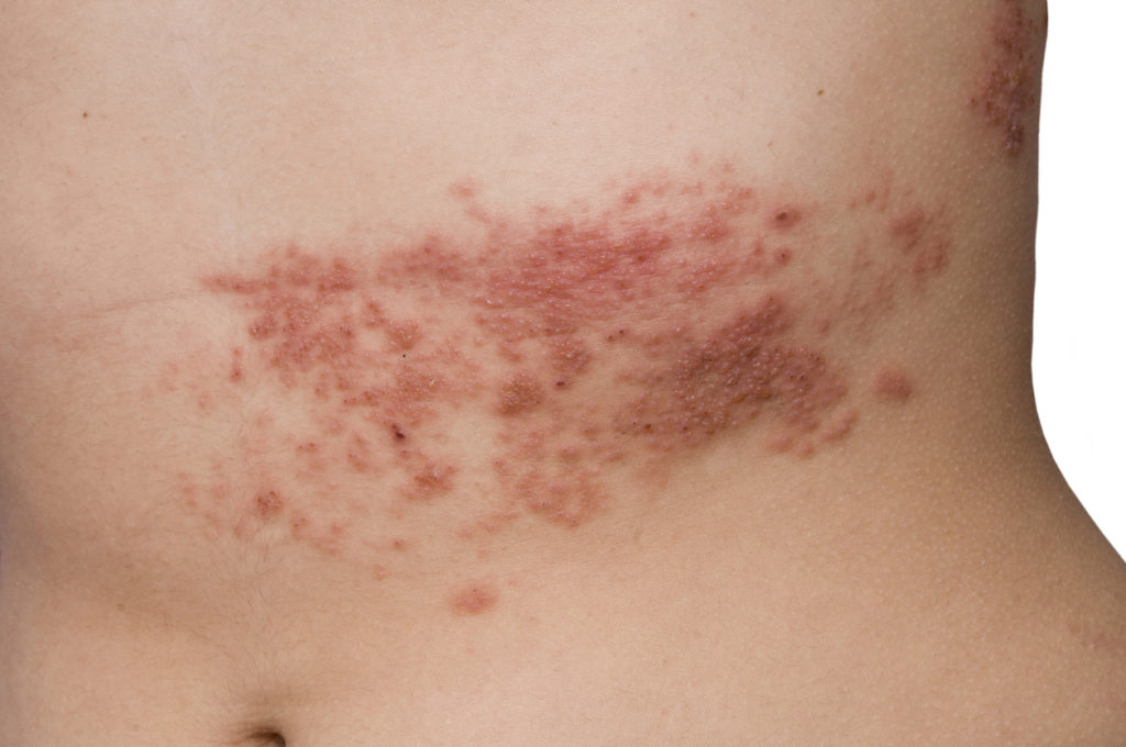 herpes zoster rash nel fuoco di sant'antonio