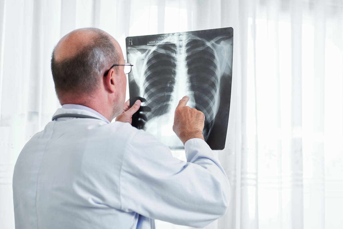 La Fibrosi Cistica Tra Sintomi Diagnosi E Terapie Disponibili