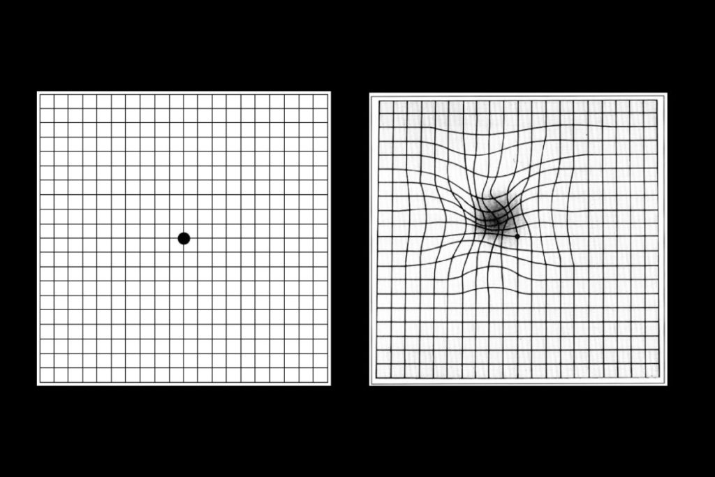 Test di Amsler a cosa serve la griglia per la degenerazione maculare Test di Amsler a cosa serve la griglia per la degenerazione maculare