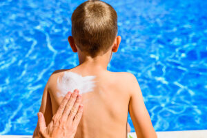 Scottatura solare rimedio con crema
