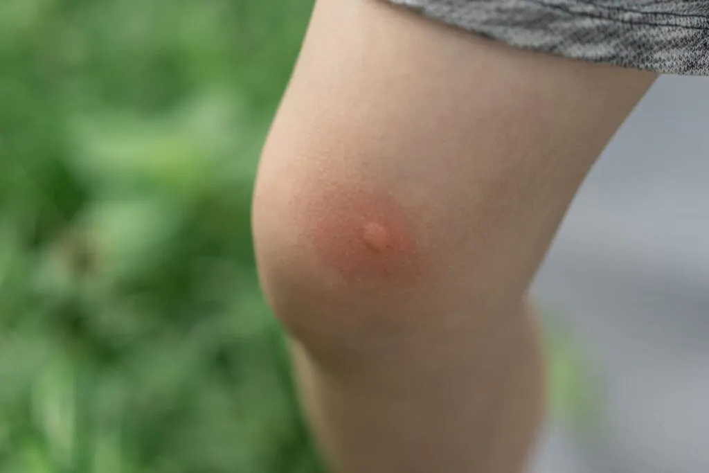sintomi allergia alle punture di zanzare