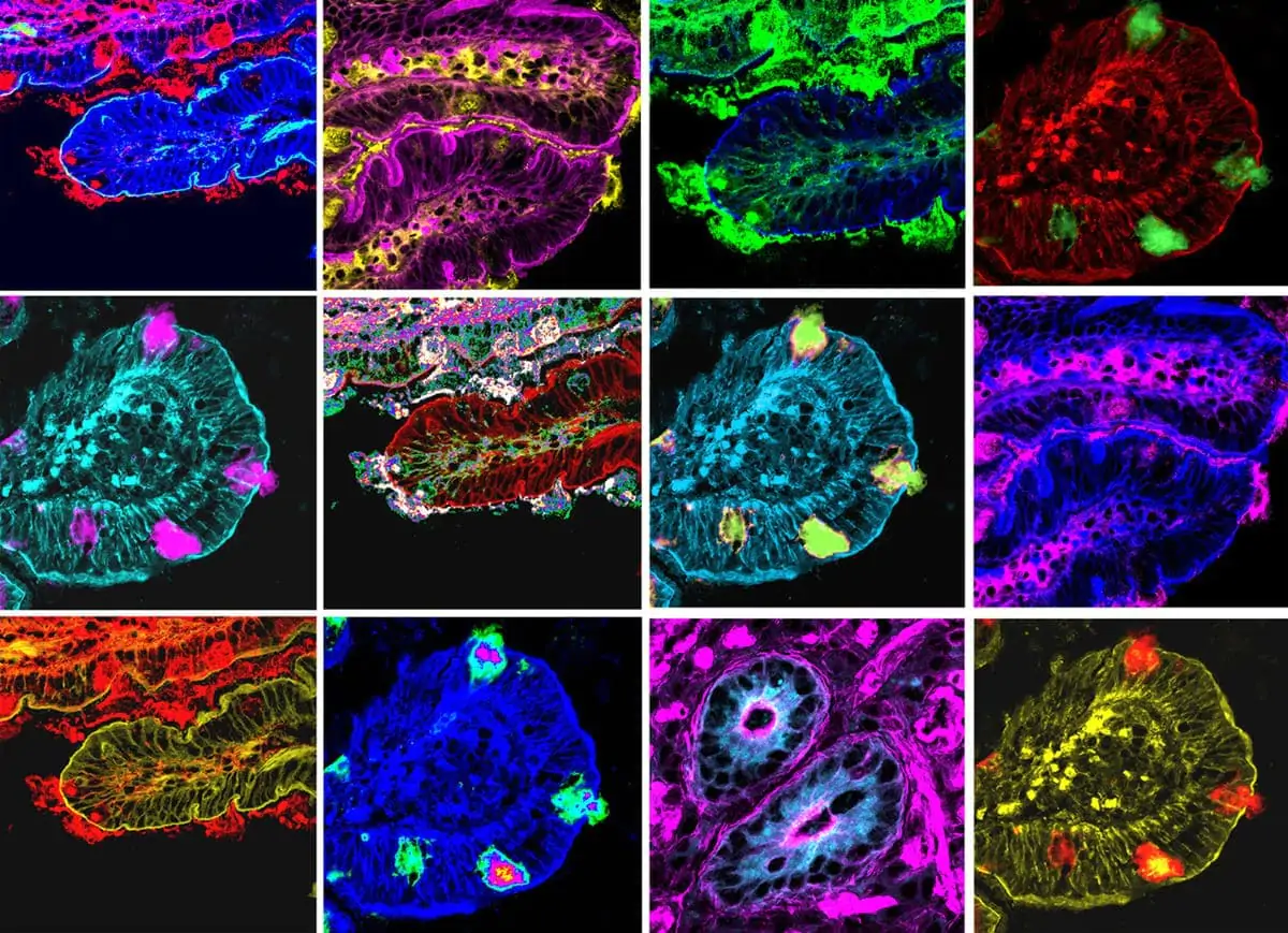 Bambino Gesù: scoperte nuove “impronte” dell’emicrania nel cervello e nell’intestino dei bambini